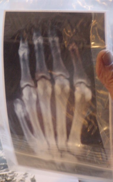 The Hand of Unknown Origin X-Ray