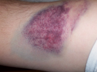 bruise